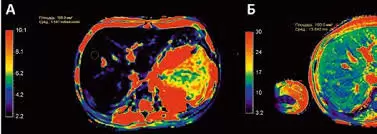 Концепции МРТ количественного определения железа в печени – будущее современных мультипараметрических методов